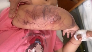 Sứa đốt khi tắm biển, bé 7 tuổi nhập viện trong tình trạng mất ý thức